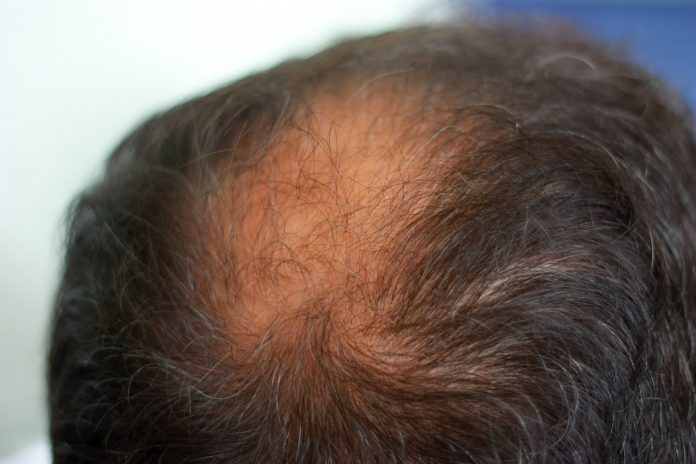 hair loss myths