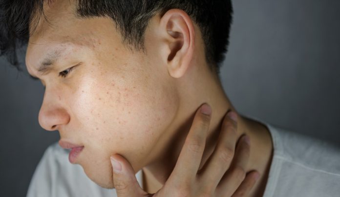 man-with-acne-problem