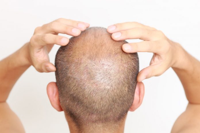 worried about hair loss
