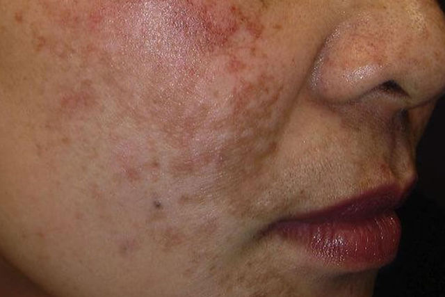 Laser for Hyperpigmentation Singapore