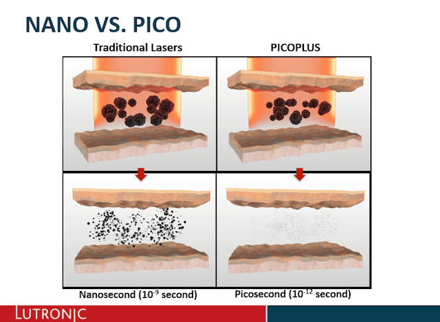 Laser Skin Pigmentation Removal Singapore