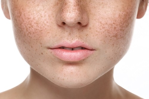 Pico Laser Treatment Singapore