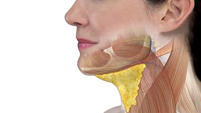 Double Chin Reduction Singapore