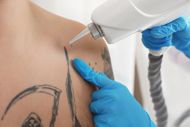 Best Tattoo Removal Laser In Singapore