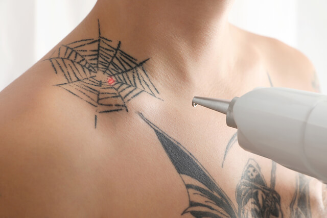Pico Laser Tattoo Removal Cost Singapore, HIFU Treatment Cost