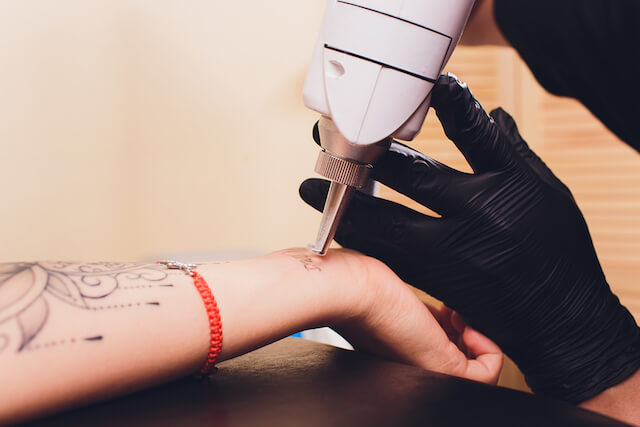 Best Tattoo Removal Laser Singapore, Best Tattoo Removal Singapore Best Tattoo Removal Laser Singapore, Best Tattoo Removal Singapore