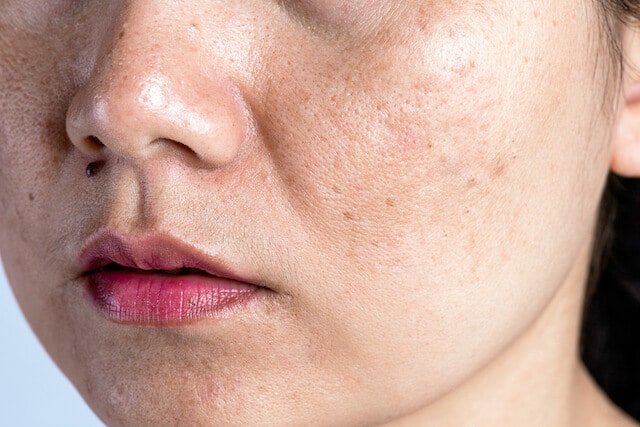 affected-by-hyperpigmentation-these-remedie-may-help