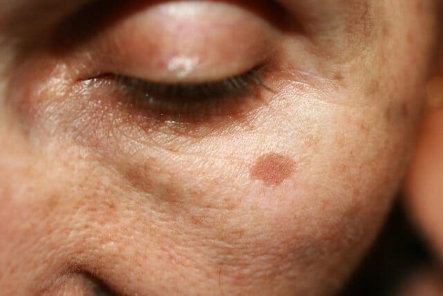 understanding-hyperpigmentation-causes-and-removal-methods